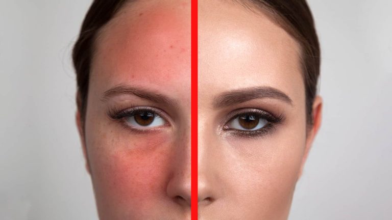Say Goodbye to Redness: 7 Powerful Ways to Reduce Redness On The Face