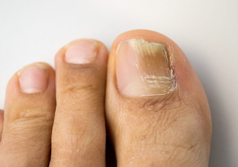 Banish Nail Fungus for Good: Effective Ways to Get Rid of Nail Fungus