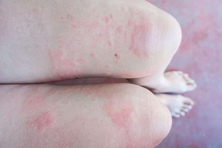 Say Goodbye to Stubborn Indurated Skin