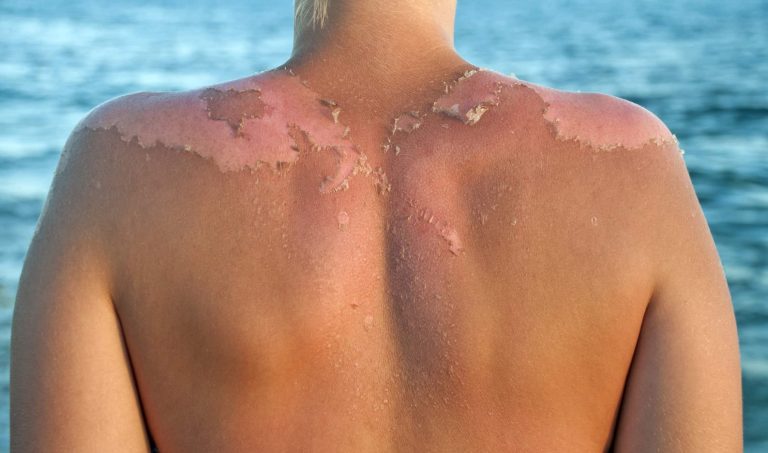 Say Goodbye to Sunburn Peeling Forever!