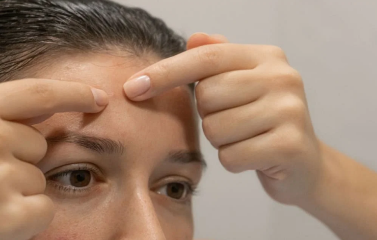 5 Surprising Ways to Banish Pimples on Your Forehead