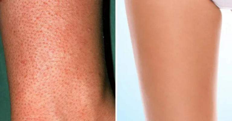 Delicious Ways to Get Rid of Strawberry Gels