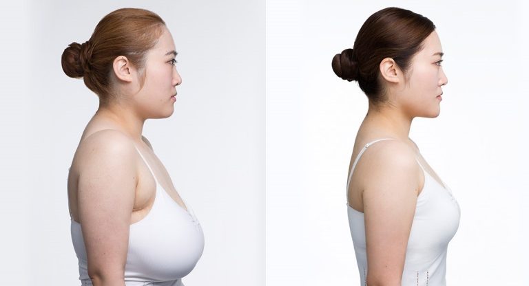 The Ultimate Guide on How to Reduce Breast Size Naturally