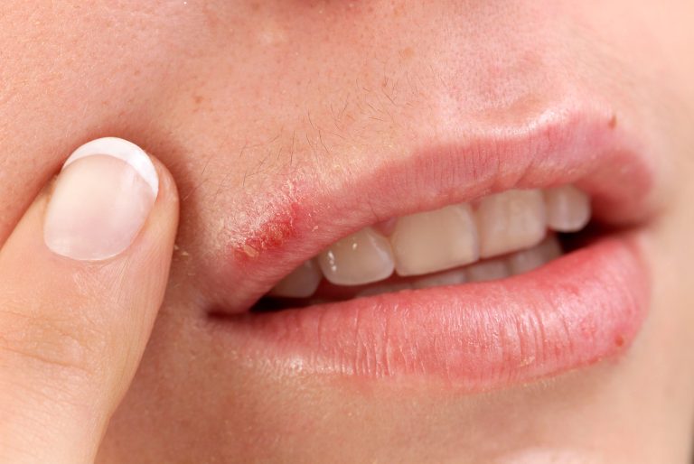 Say Goodbye to Annoying Cold Sores with These Effective Remedies