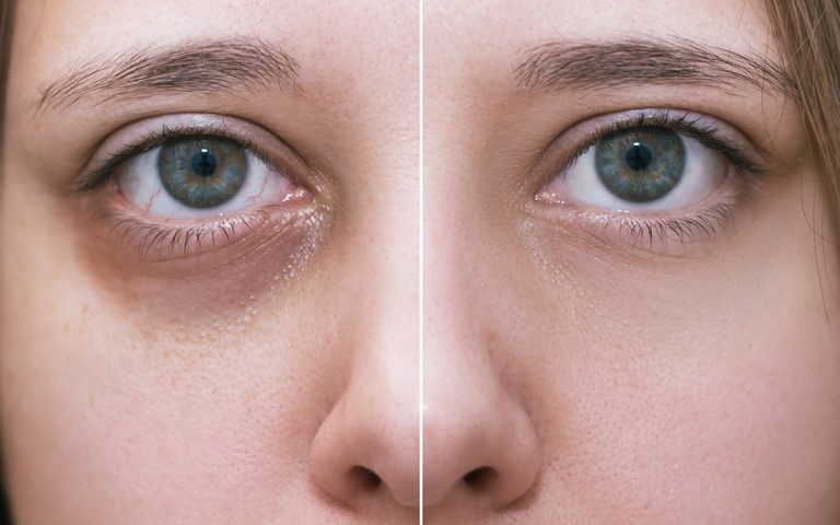 Top Secrets to Eliminate Dark Circles