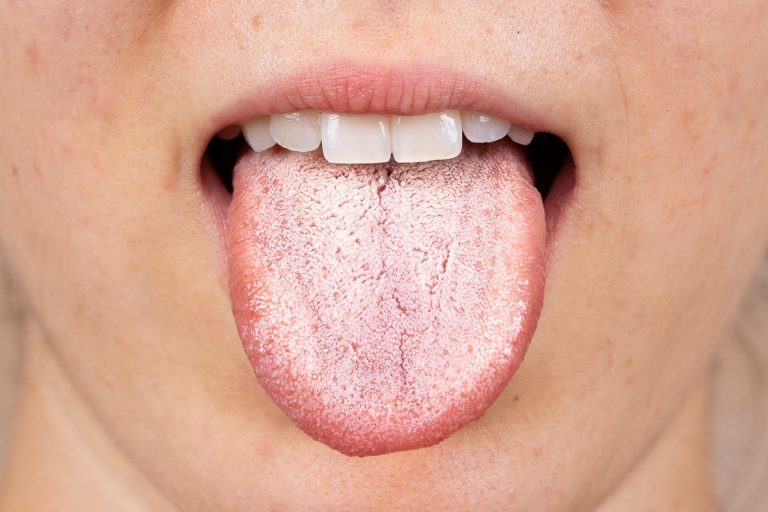 Overcoming Oral Thrush: Effective Remedies You Need to Try